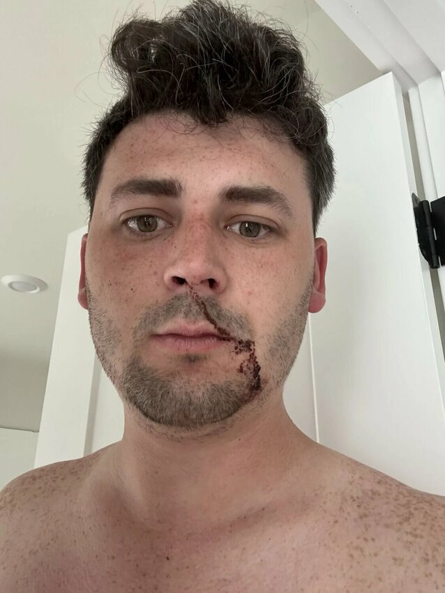 Cam Higby after concussion and other injuries caused by Antifa during ICE protest in Seattle June 14, 2025