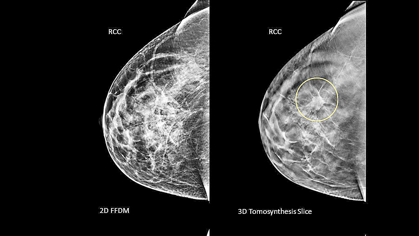 East Lewis County Hospital Foundation Raising Funds For 3d Mammography Unit The Daily Chronicle 1120