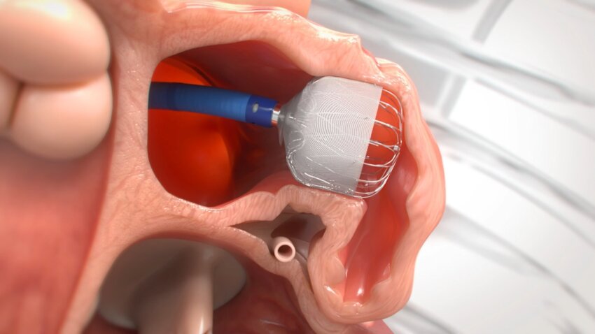 PeaceHealth Southwest Medical Center has completed its 2,000th implantation of the WATCHMAN cardiac device, which helps reduce stroke in patients with atrial fibrillation by sealing off a part of the heart where blood clots commonly form.
